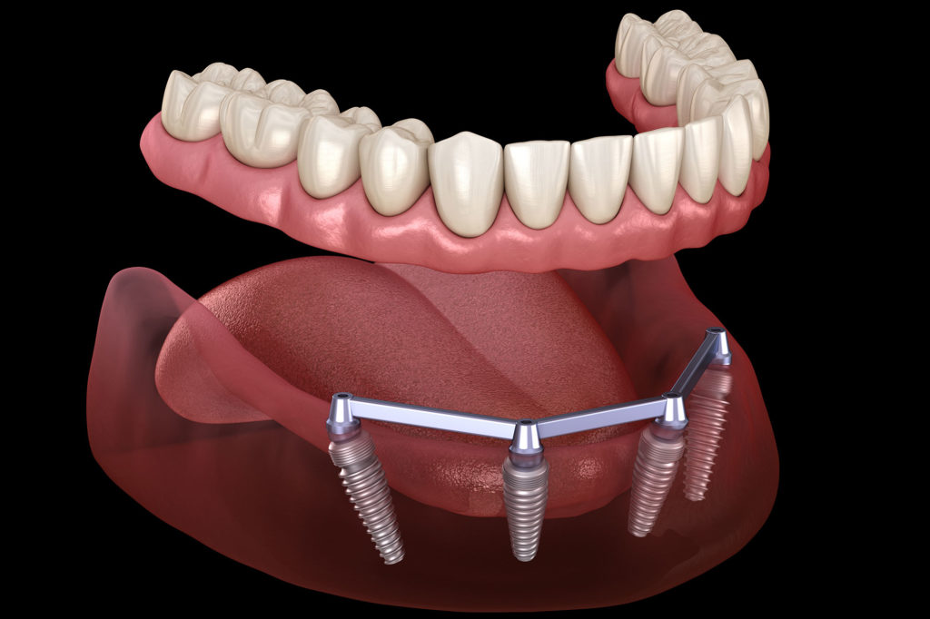 Implant supported dentures Frank Sparacino DDS North Charleston, SC