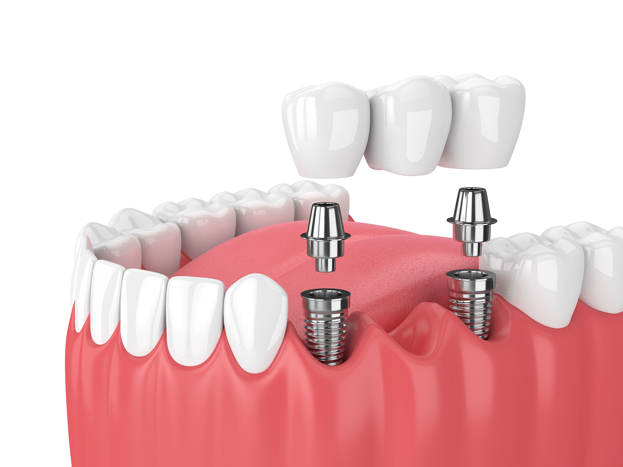 Dental Implants Frank Sparacino DDS North Charleston, SC