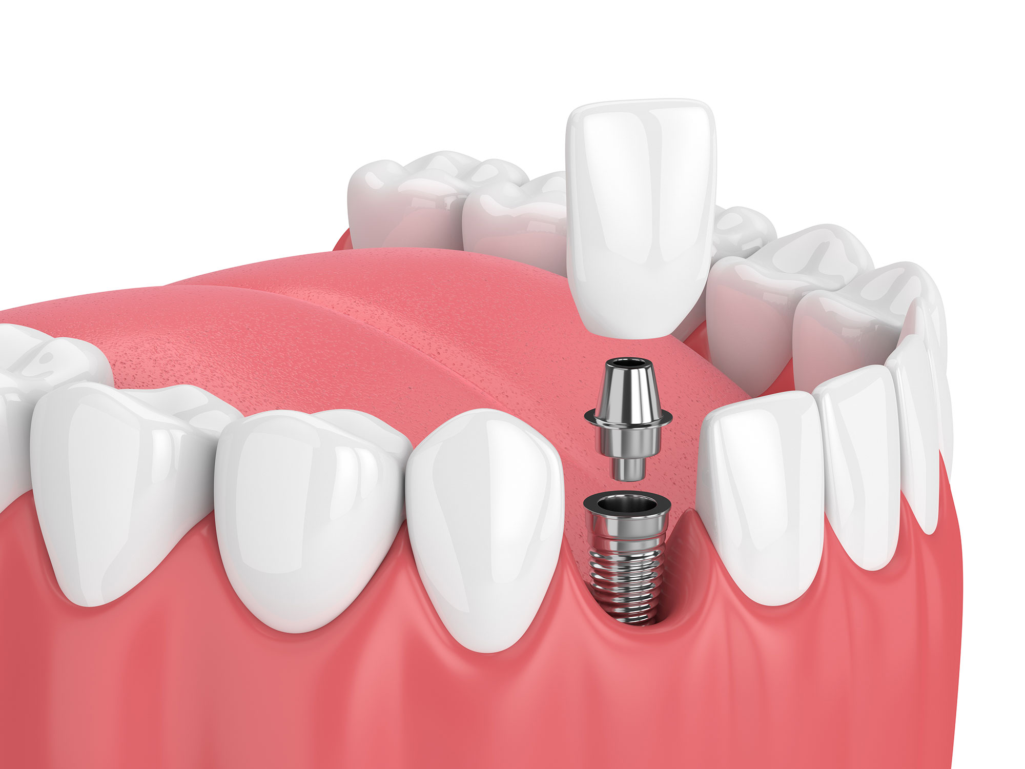 Dental Implants Frank Sparacino DDS North Charleston, SC