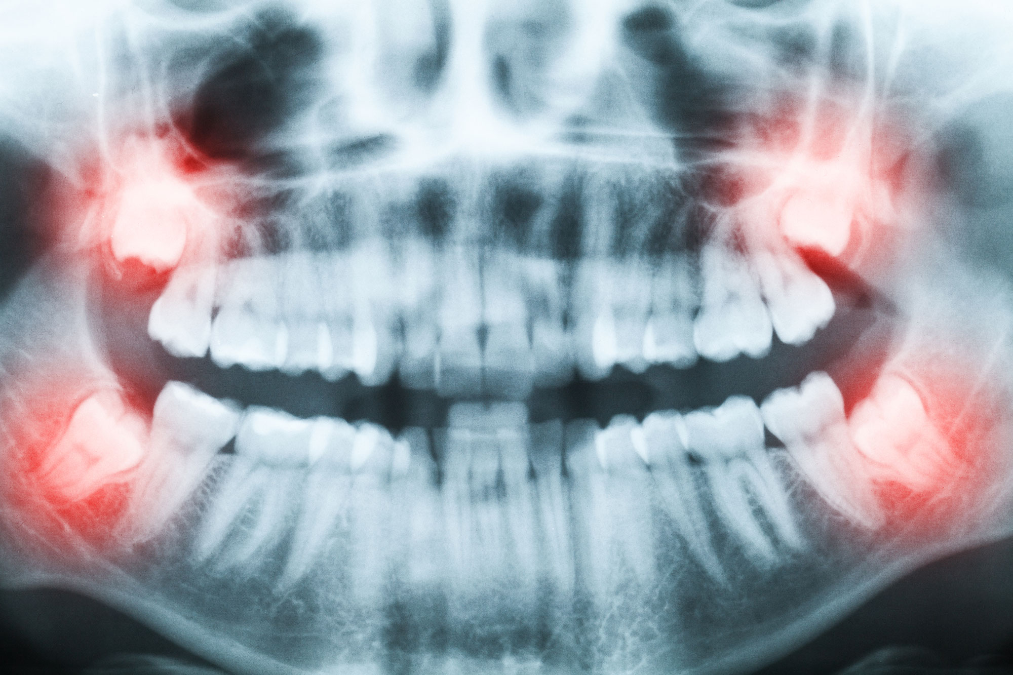 wisdom teeth extractions North Charleston, SC